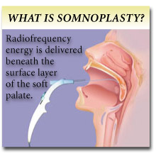 What is Somnoplasty diagram